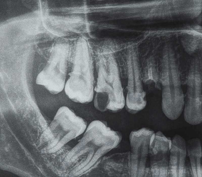Endodonzia