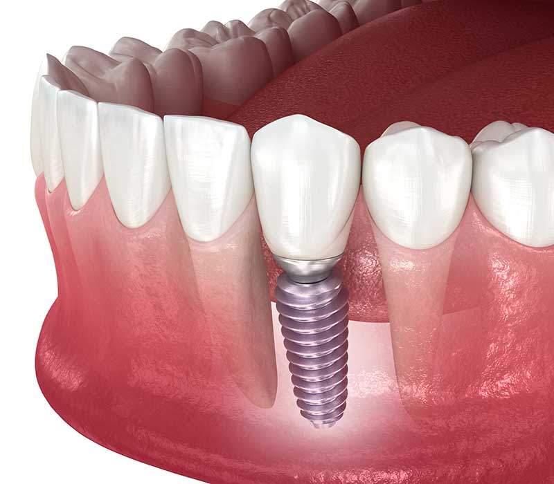 Immagine impianto dentale
