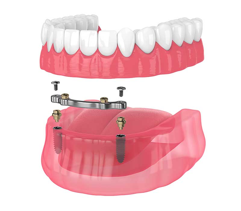 Immagine trattamento dentale